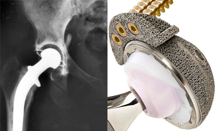 China Approves the Use of 3D Printed Hip Replacement – Geeetech